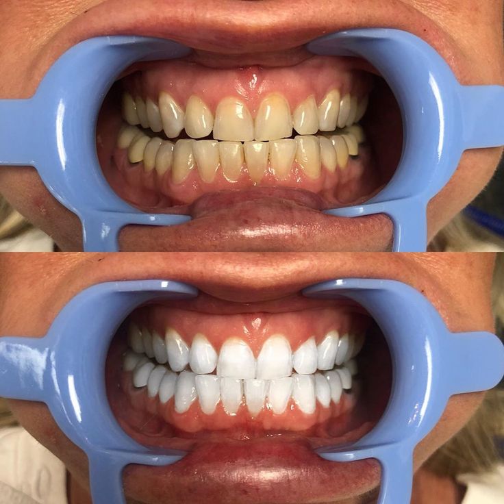 Teeth Whitening